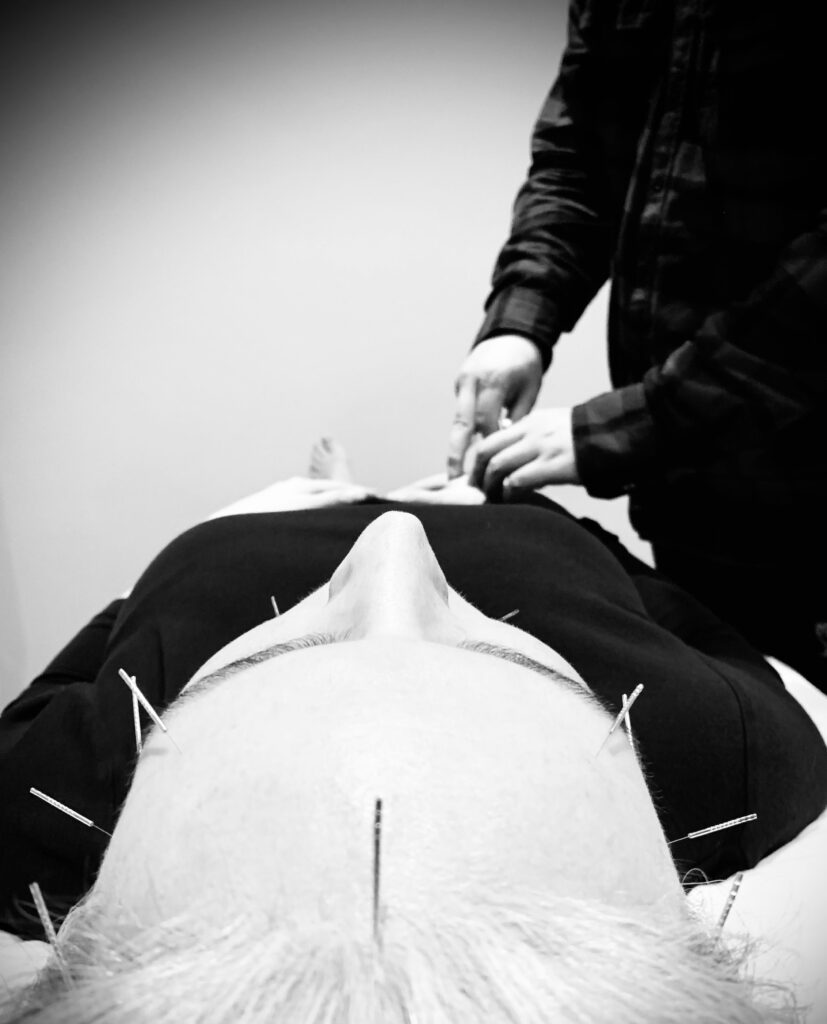 Cosmetic acupuncture Cosmetic Acupuncture Aurora